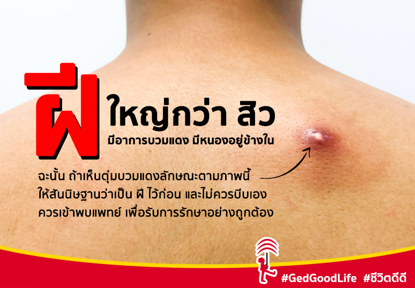 ฝี คืออะไร ใช่สิวหรือไม่ บีบเองได้ไหม? มาดูคำตอบ พร้อมสาเหตุ อาการ วิธี ...